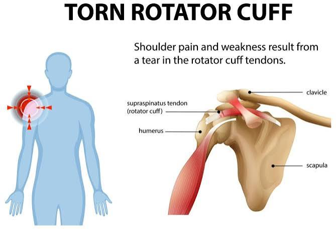 Rotator Cuff and Shoulder Pain: Assessment, Rehabilitation, and When Imaging Actually Changes the Plan